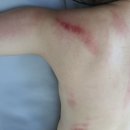 광안동 피부관리 등 후면관리 약손유림에스테틱 솔직후기