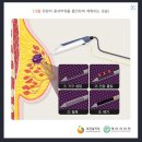 초음파유도하 진공보조장치를 이용한 유방 양성병변 절제술[유방암 (C50), 상피내암 (D05)] 이미지