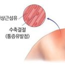 담걸리는 이유 담걸렸을때 증상 담푸는법 및 약 파스 운동 : 어깨 목에 허리 근막통증증후군 이미지