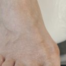 레푸스죽전새터점 | 수지 내성발톱은 레푸스 죽전새터점 !