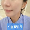 카이저 | 해운대 성형외과 카이저레이저 일주일 경과 후기