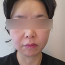 홍대 피부과 무중력 실리프팅 시술전.후 솔직후기(서이추 환영)