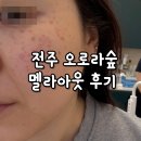 주정차-33 | 전주피부관리 오로라숲 기미 주근깨 제거 후기
