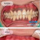 연세건강한치과의원 | 과천역 치과 잇몸이 검게 보인다면, '잇몸미백'이 해답이 될 때가 있습니다