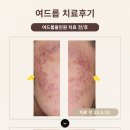 나노필의원 | 대방동 여드름 치료 피부과 후기, 효과적인 여드름 치료