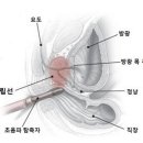 전립선 초음파 검사[Prostate ultrasonography] 이미지