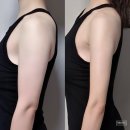 (주)팀네버루즈 | 팔뚝지방분해주사 5회차 솔직 후기 (강남지방분해주사 인바디 체지방변화 및 눈바디 비포에프터)