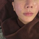 청담피부과 볼뉴머 600샷 받아본 내돈내산 후기 일명 박서준 리프팅