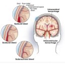 ■ 지주막하 출혈(Subarachnoid hemorrhage) 원인.증상.치료 이미지