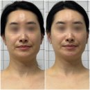 성관빌딩 파리바게트 앞 | 부산서면두골비 관리 로온 얼굴안면비대칭 &amp; 자이로토닉 후기