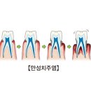 만성 치주염(Chronic periodontitis) 치과질환이란? 이미지