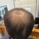 우두머리 | 울산두피문신 원형탈모 커버 고민하고 있다면 꼭! 확인해야 하는 우두머리 후기!