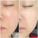 신정약초 | 울산맞춤피부관리 잘하는 곳 올가드림뷰티 미소지움점 모공디톡스 리얼후기