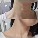 강남피부과에서 받은 목주름 튠아이즈 스킨보톡스 후기