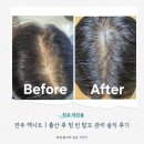 전주두피문신ㅣ출산 후 탈모 관리 엑시트에서 솔직 후기ㅣ전주탈모관리