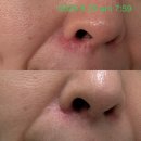 코스코약국 | 성인 농가진&gt;단순 포진&gt;모낭염 3(진행 중, 🇨🇦 홈 케어)