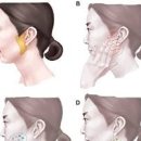 이하선 종양 증상 원인 수술 귀밑 침샘 멍울 이미지