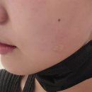 볼륨댄스 | 옆볼꺼짐 땅콩형 얼굴 올리디아볼륨 내돈내산 3회차 후기