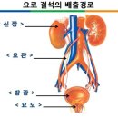 재발 많아… 물 많이 마셔 예방을 이미지