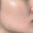 명성메디칼 | 주근깨 루비레이저 기미잡티제거 후기 내돈내산 관리 벌써 5회차 후기 ft. 통증