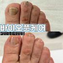 장안약국 | 장안동 문제성발톱 관리 바이오풋케어 장안점 방문 솔직후기 (무좀발톱·내성발톱)