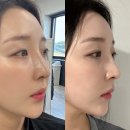 경기광주 태전동피부과 코실리프팅 하이코 후기 :엘라스티 실리프팅 포르테 더블