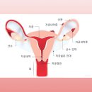 동국대학교 경주한의원 | 심부자궁내막증이란? 증상, 진단, 수술, 회복이 모두 어려운 이유