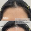 여름 대비 필수 I 천안두정 멜팅왁싱 여자 헤어라인 왁싱 예약 폭주 중!