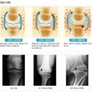 ＜ 무릎인공관절수술 ＞어떤 질병에 수술을 하나요?? 이미지