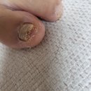 수성구 발톱무좀 _악성 발톱 무좀 신세계를 맛보다(메디컬풋케어&amp;베어푸스플레게)