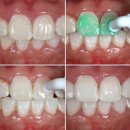 단계반점 이미지