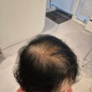 정수리 | 송파두피문신 50대 여자 탈모 정수리두피문신 후기(2편)
