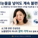 쇼그렌증후군 안구표면 변화, 눈물샘보다 결막이 먼저 손상될 수 있을까요?