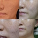 강남역 피부관리 한의원 콜라겐컨택터 크라이오셀 스킨부스터 내돈내산 비용 후기