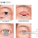 눈암, 안구암 및 (결막 종양, 흑색종, 생존율) 이미지