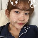 수지 눈 점 제거 결막모반 레이저 제거 후기 • 비용