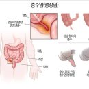 인류의 수명을 거의 두배로 늘려준 수술 이미지