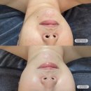 이리산소 | 군산 피부샵 보금뷰티 피코토닝 , 크레이지 , 물방울 리프팅 , 산소테라피 관리 후기