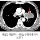 비소세포성 폐암 (Non-Small Cell Lung Cancer) 이미지