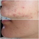 메디인 | [내돈내산]메디인랩 A3앰플 여드름 탈출 후기