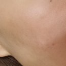 미화피부관리실 | [ 피코프락셀 솔직한 일자별후기 ] 깐달걀 되는법 / 다운타임? 정말 아파요?