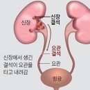 여름에 환자 껑충… '요관·신장 결석' 주의 이미지