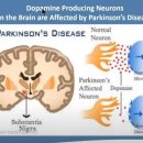 절박한 파킨슨병 치료 어디까지 왔나? 이미지
