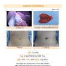 담낭용종수술후기. 건강검진 하면서 위내시경이랑 복부초음파 검사했는데 생각지도 못한 담낭에 용종발견 ㅠㅠ 이미지