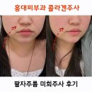 나주사 | 팔자주름없애기 : 홍대피부과 미희주사 후기-콜라겐주사 효과