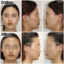 교선한의원 | 서울대입구한의원 안면비대칭 교정치료 #6. 10회차 비포애프터 후기