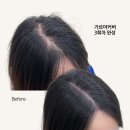 정수리, 가르마탈모 파격SMP (19만) 이미지