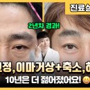 아내가 좋아하는 중년남성의 수술은? 2년차 하안검,이마거상,이마축소,눈매교정 실제 경험담 이미지