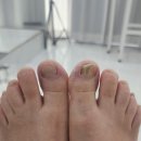 레푸스 | [레푸스] 광명역 문제성 발톱 전문 관리샵, 레푸스 방문 후기 ✨