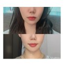 이노피부과의원 | 피부과 바노바기 대전점에서 올타이트리프팅 받고왔어요 심부볼 삭제, 처진 얼굴 개선 후기!